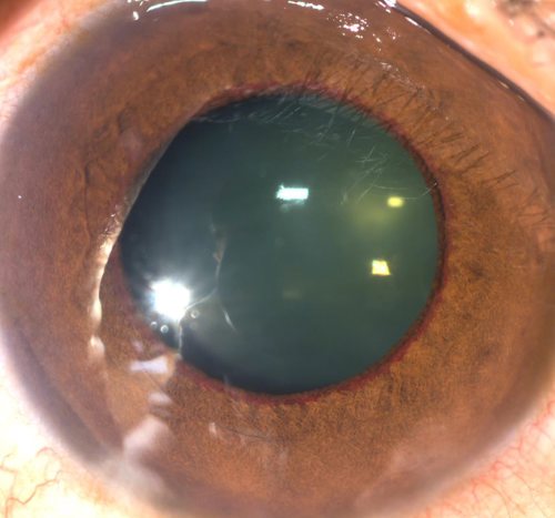 Neovascular glaucoma - eyeonoptics