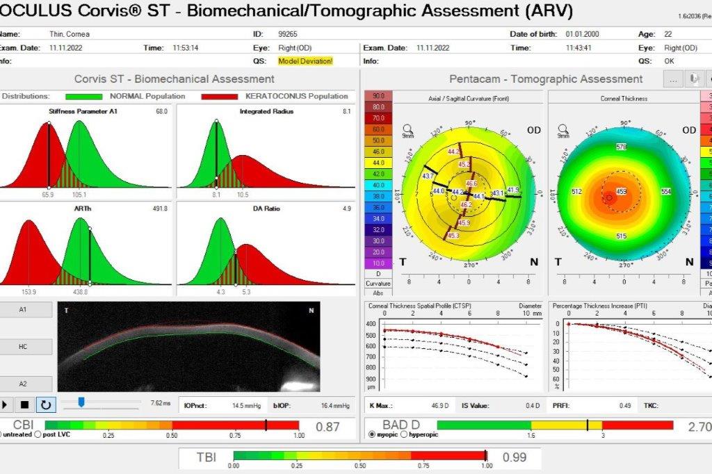 Mitigating ectasia risk nzoptics