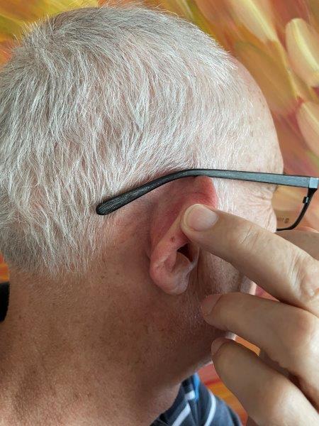 Indentation behind clearance ear from glasses