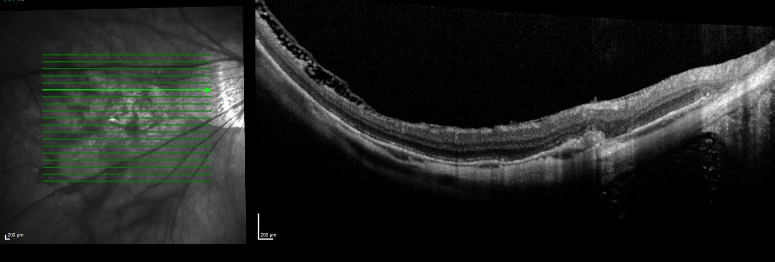Figure 3: SD OCT of the the right eye shown in figure one demonstrating a thin choroid, extrafoveal retinoschsis and a scarred myopic CNV
