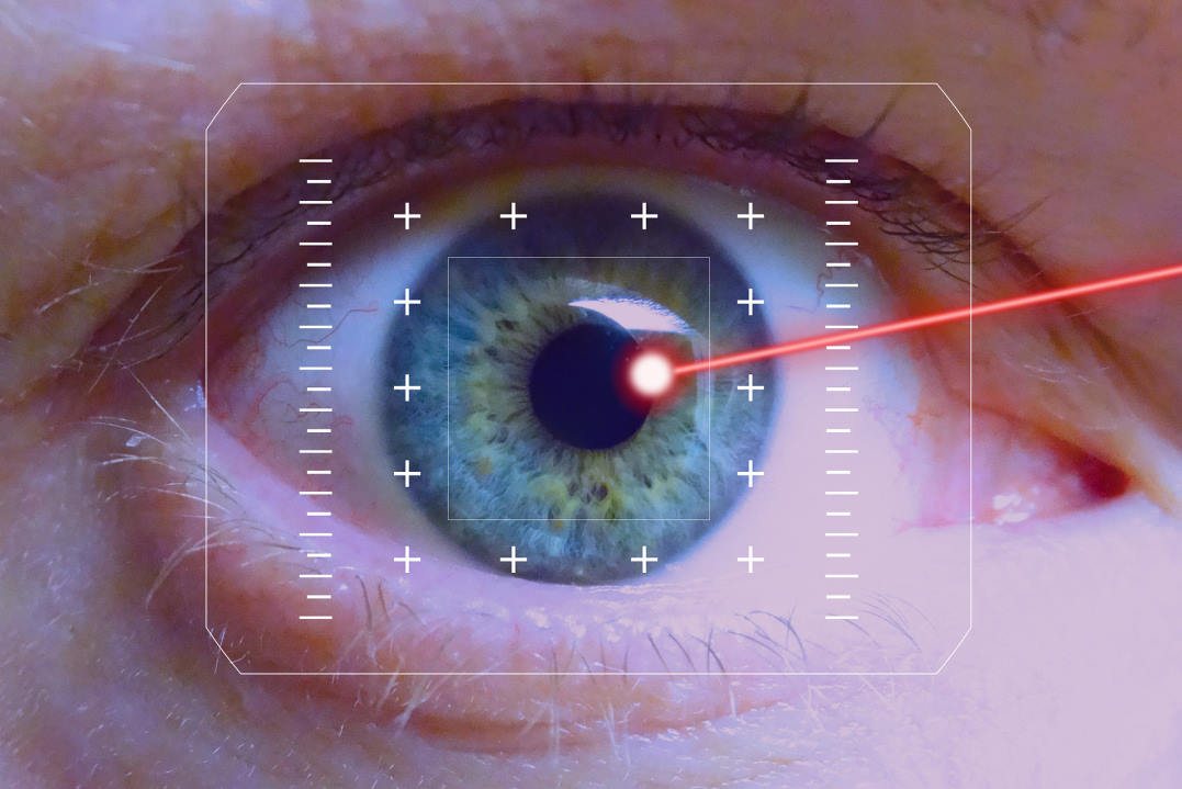 Navigated subthreshold laser in chronic CSCR